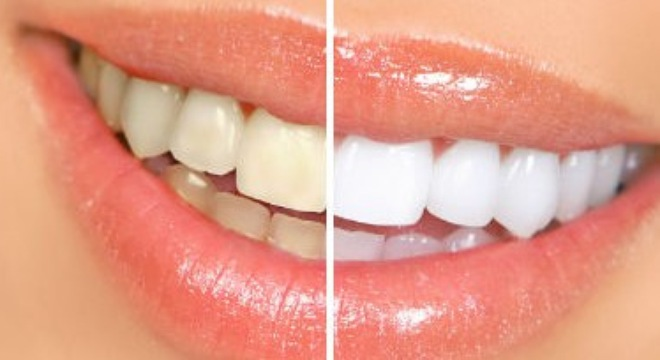 Mẹo làm trắng răng nhanh chóng trong 15 phút