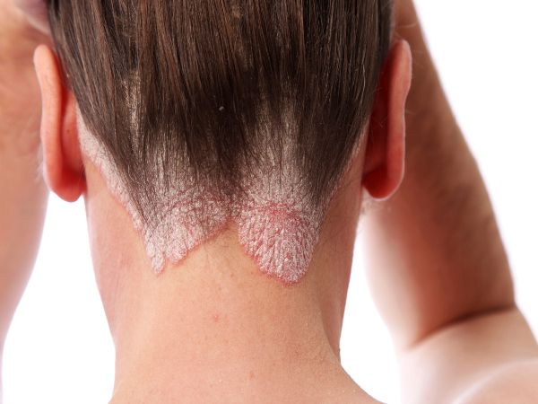 7 vị trí trên cơ thể dễ mắc ung thư da