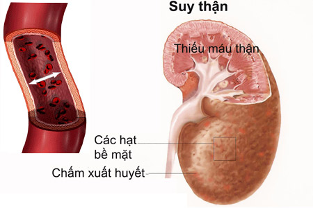 10 triệu chứng biểu hiện suy thận