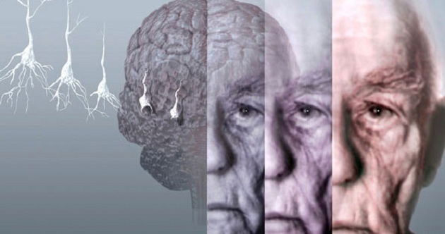 Bệnh về da cảnh báo nguy cơ Alzheimer