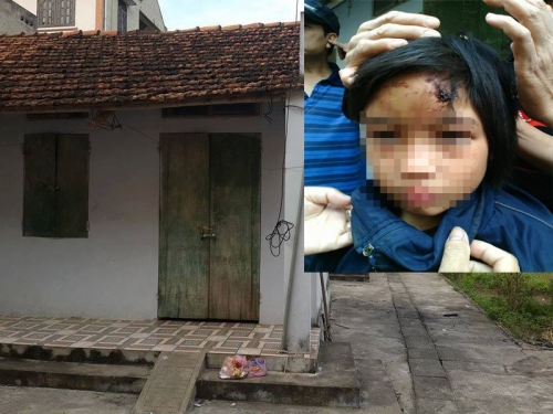Hưng Yên: Bé gái nghi bị hành hạ dã man trong chùa