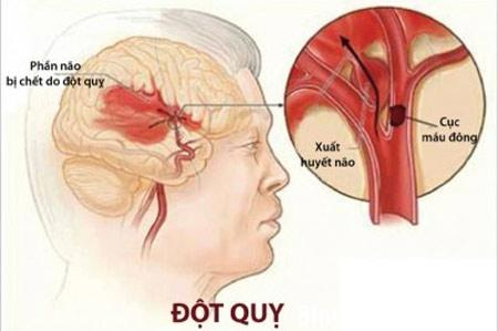 Làm gì để phòng ngừa bệnh tim và đột quỵ?