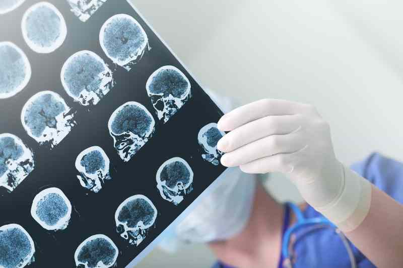Những điều còn chưa biết về bệnh Alzheimer