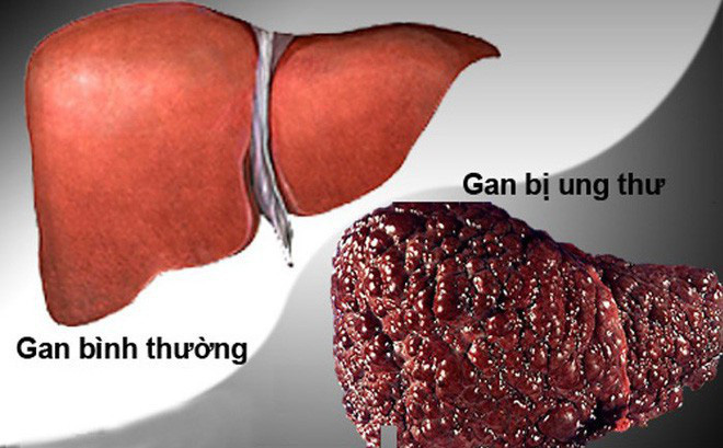 Vì sao ngày càng nhiều người chết do ung thư gan?